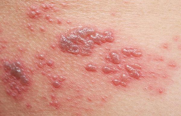 Shingles Image showing shingles skin rash 