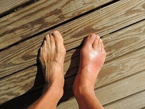 Two feet on a wooden floor.  One of the feet is swollen